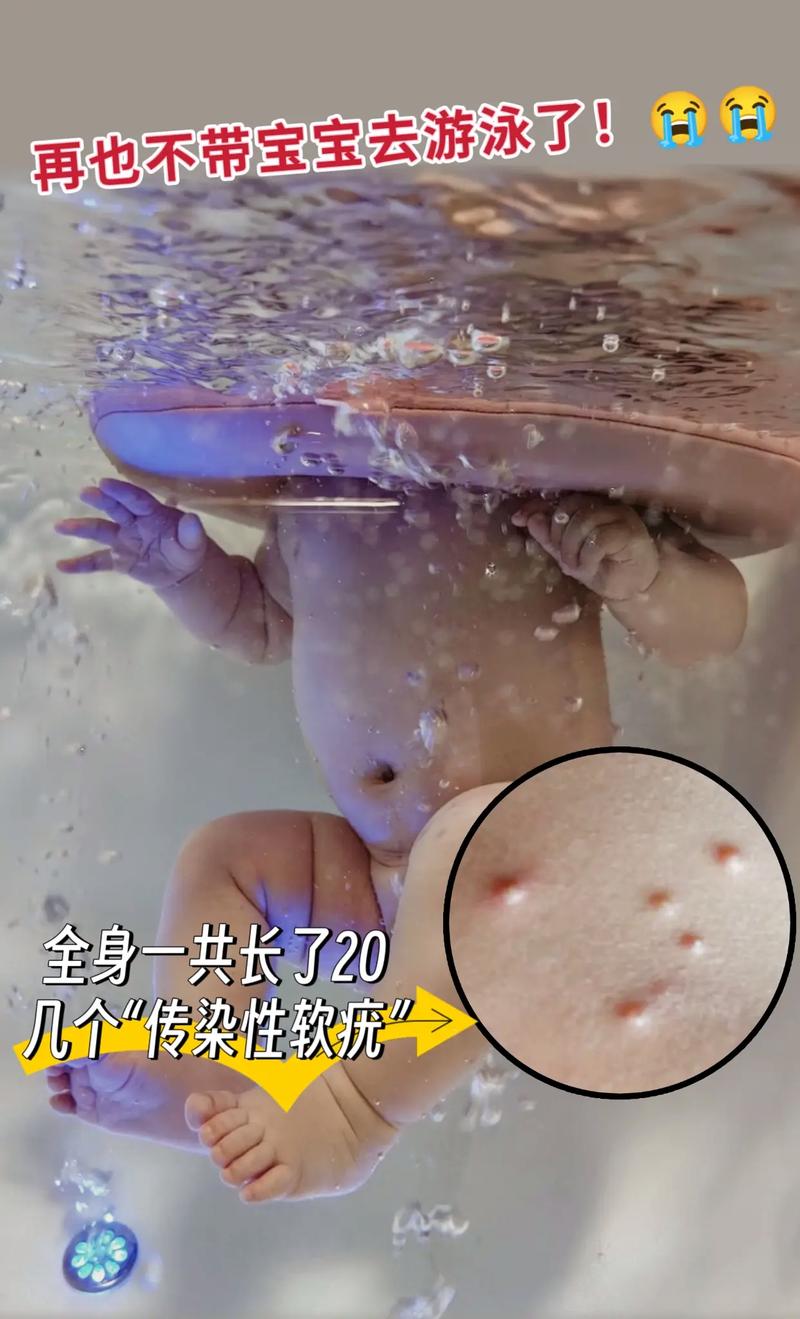 男孩去水上乐园玩水感染传染性软疣,绝对策略计划研究_社交版40.12.0